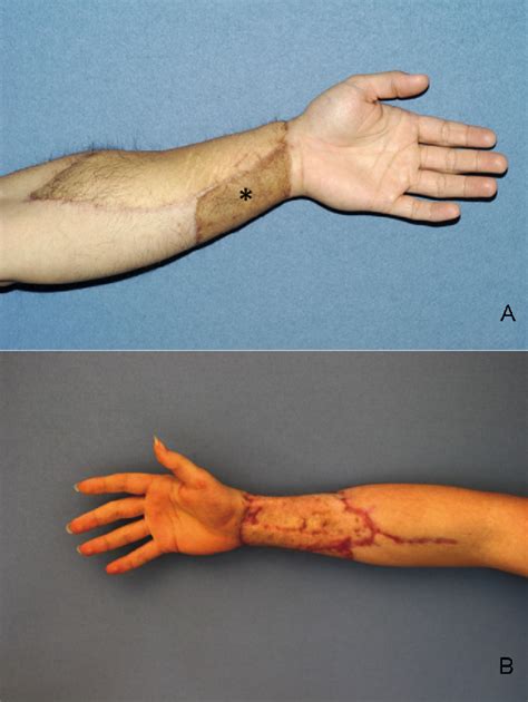 You can take steps to prevent severe scarring by following your surgeon's . . Single scar phalloplasty